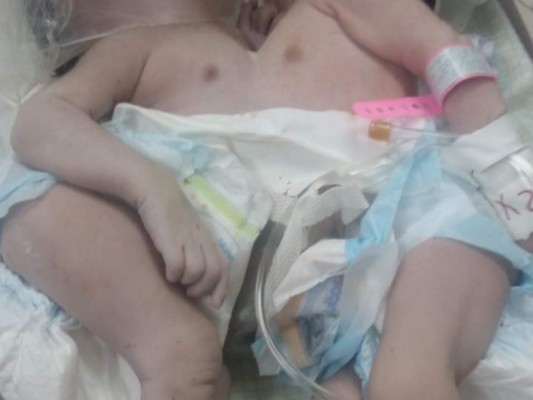 Las bebés se encuentran unidas en la parte de su abdomen, por lo que su diagnóstico es reservado.