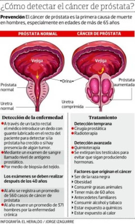 Dos hombres son diagnosticados al día con cáncer de próstata en Honduras