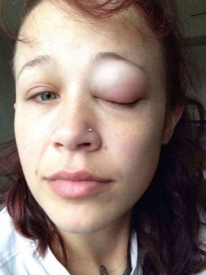 Quería verse diferente, se tatuó los ojos y sufrió las terribles consecuencias