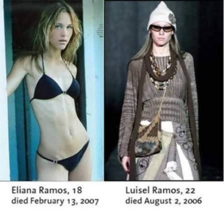 Los casos más impactantes y escalofriantes de anorexia y bulimia