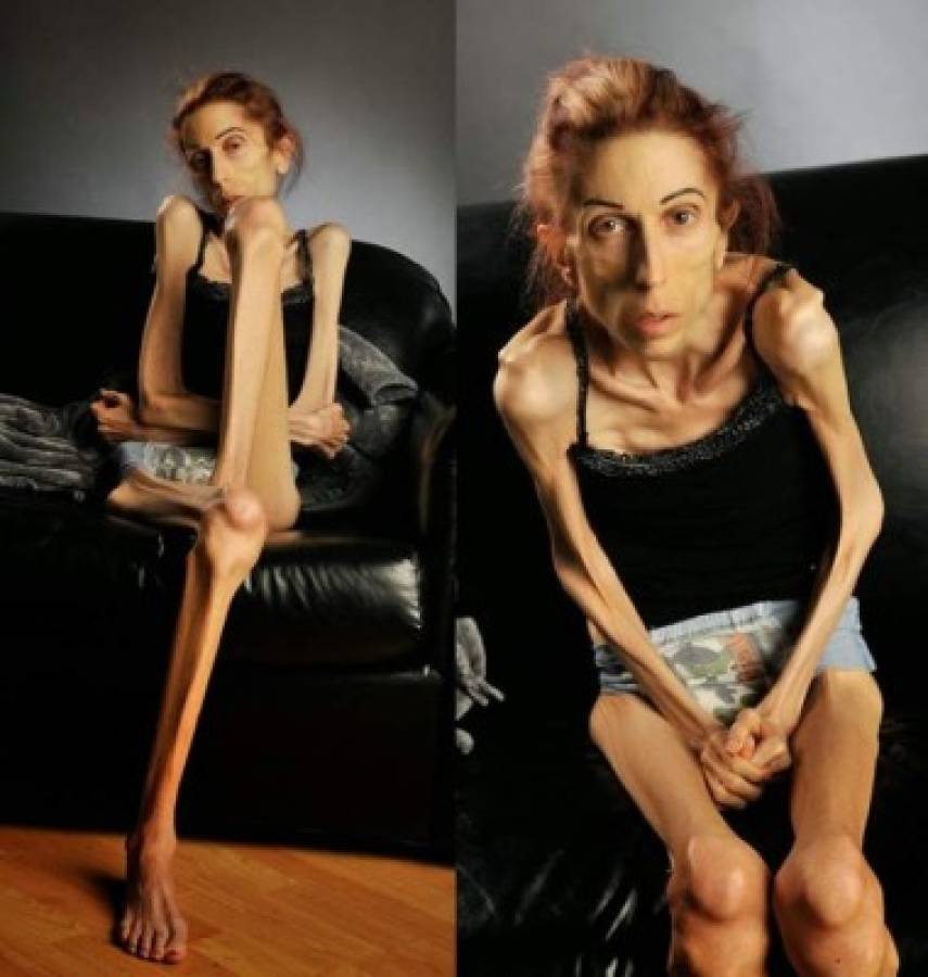 Así luce hoy Rachael Farrokh la mujer que pidió ayuda para superar su anorexia