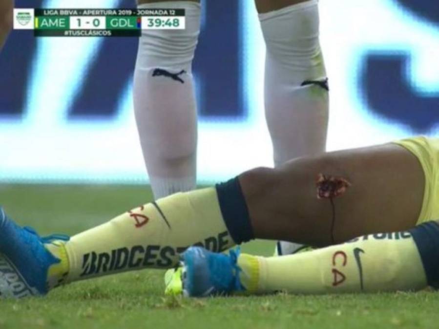 FOTOS: Ellos son los jugadores que han sufrido las peores lesiones en el fútbol