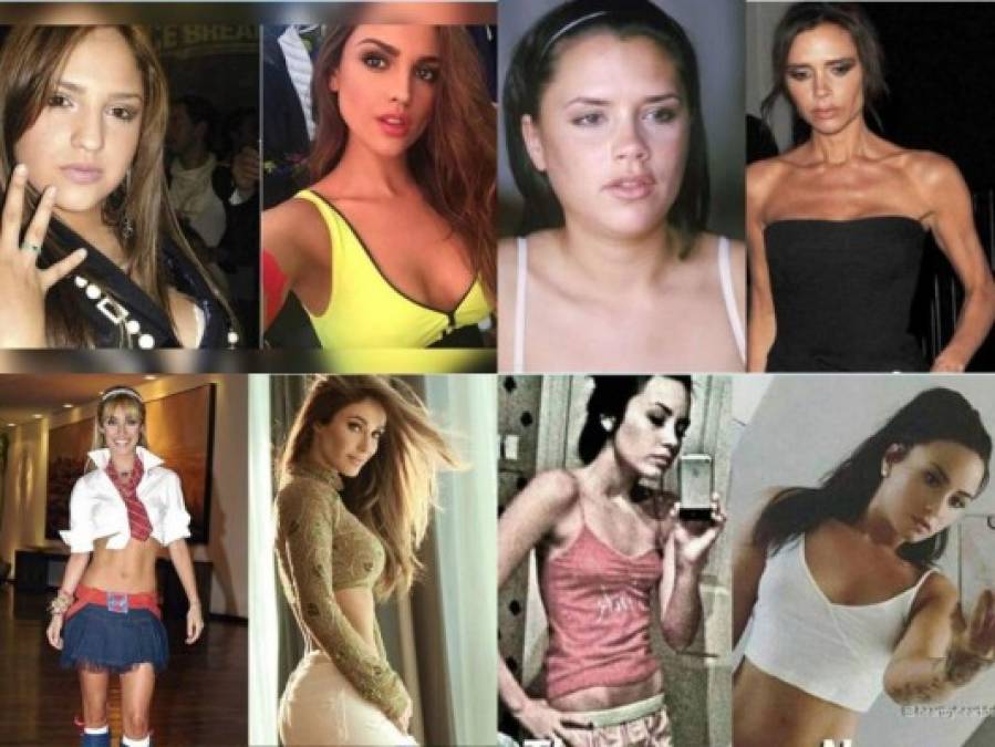 FOTOS: Famosas que sufrieron anorexia y otros problemas alimenticios