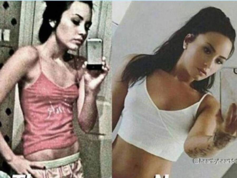 FOTOS: Famosas que sufrieron anorexia y otros problemas alimenticios