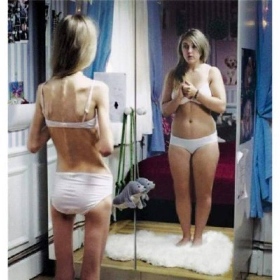Contra la anorexia