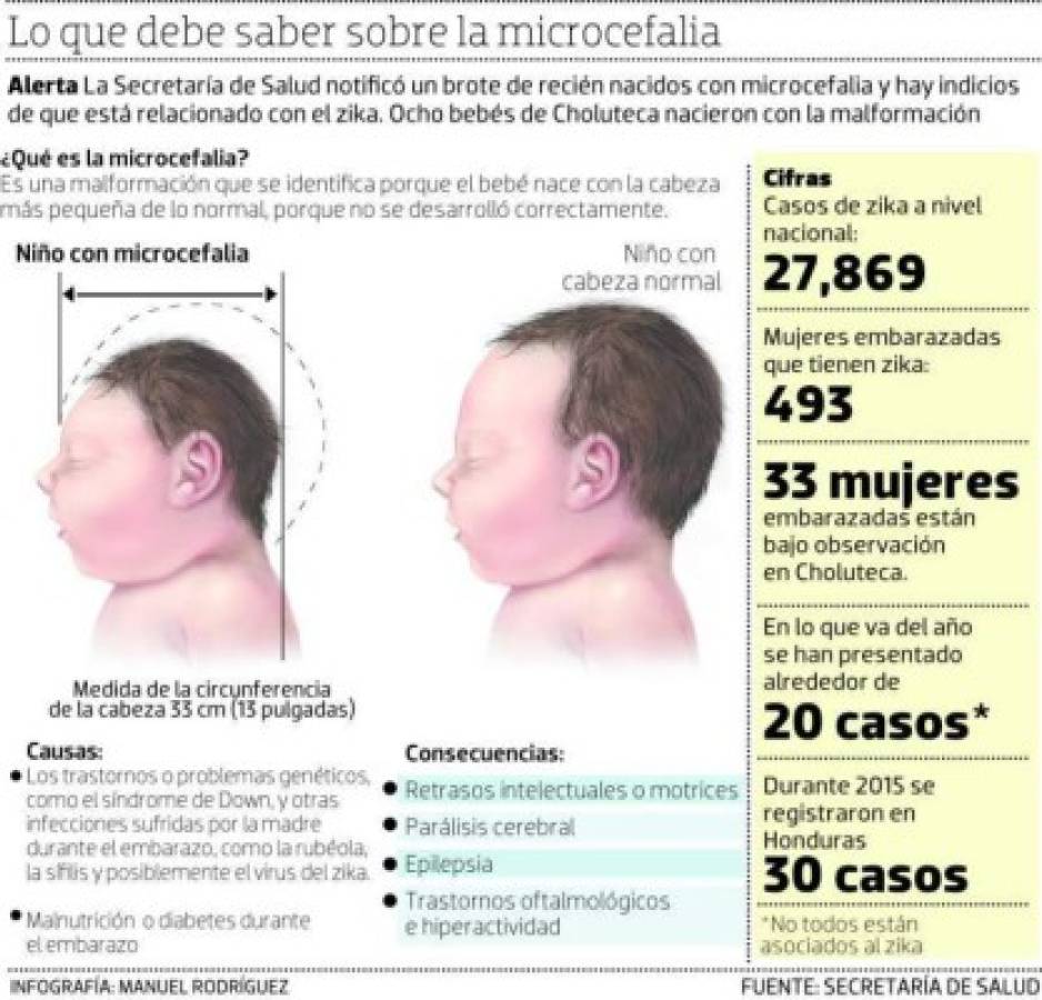 Infografía sobre la afectación de la microcefalia.