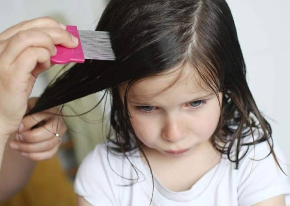 Remedios caseros para eliminar piojos y liendres de forma rápida