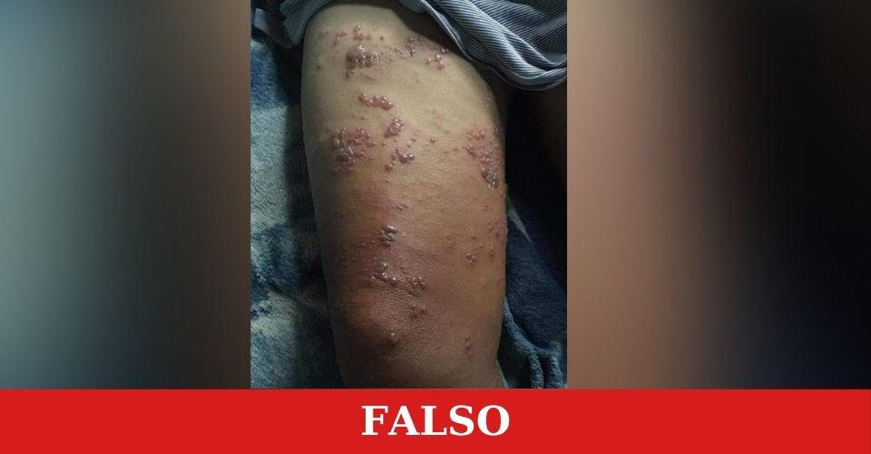 Esta fotografía circula en varias páginas de Facebook de Honduras. Supuestamente ilustra un caso de viruela del mono en el país.