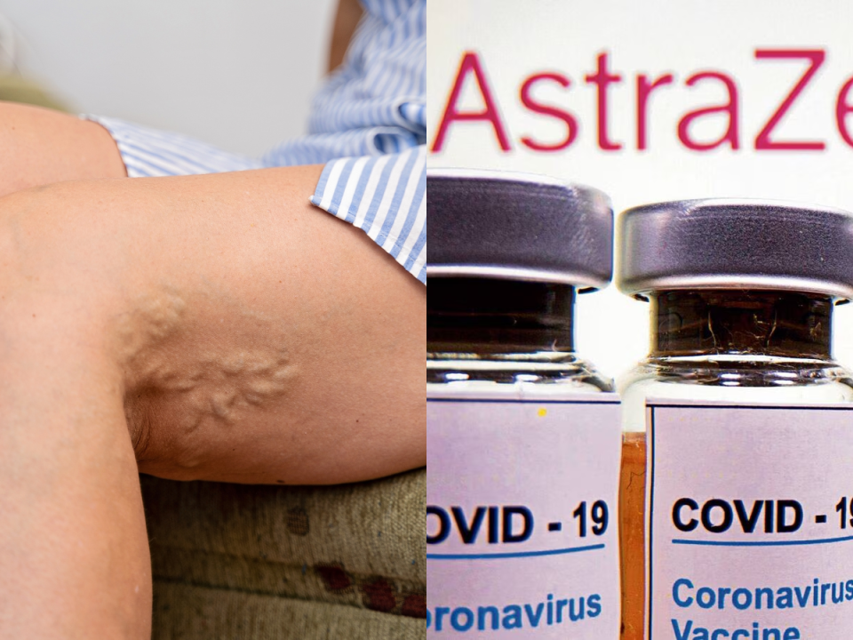 Estos son los algunos de los efecto secundario que pueden tener algunas personas que se vacunaron con la AstraZeneca.