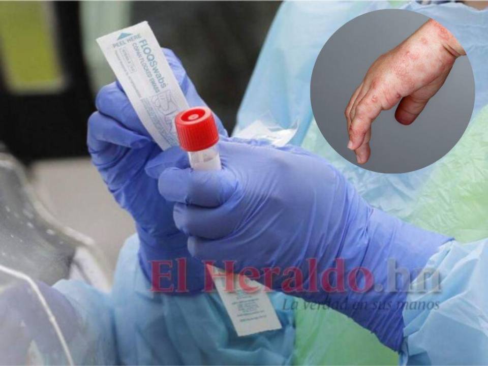 Las pruebas para confirmar los seis casos sospechosos de viruela símica se enviaron de SPS a Tegucigalpa. Se esperan los resultados para el lunes.