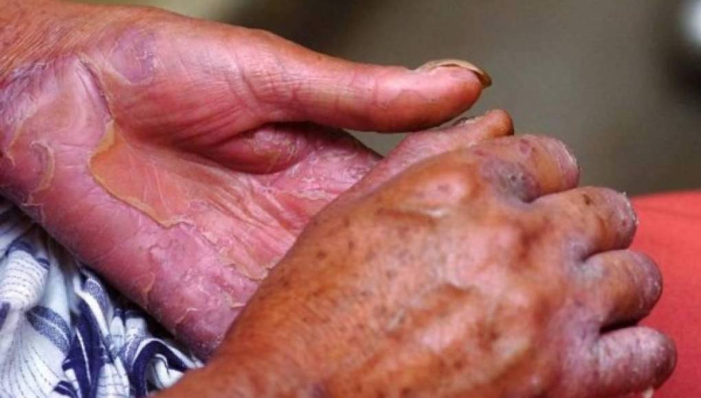 Alerta en Honduras por 16 casos de lepra: ¿cuáles son los síntomas y cómo protegerse?