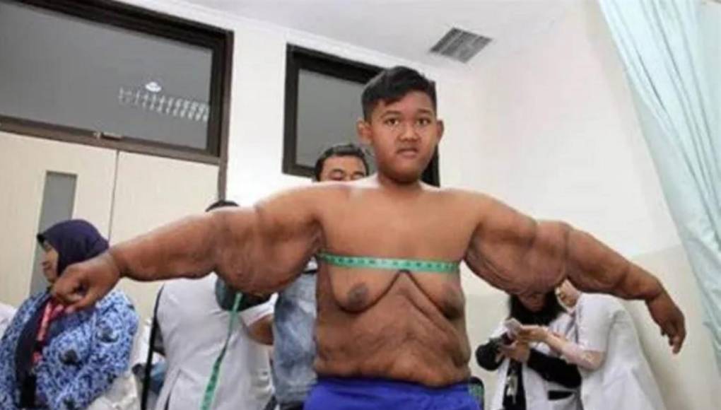 El impactante cambio físico de Arya Permana, el niño más gordo del mundo
