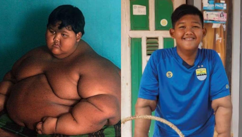 El impactante cambio físico de Arya Permana, el niño más gordo del mundo