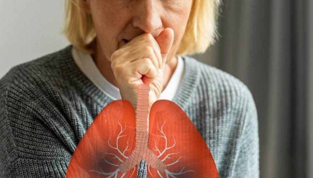 ¿Qué es bronquitis aguda, enfermedad diagnosticada a la presidenta Xiomara Castro?