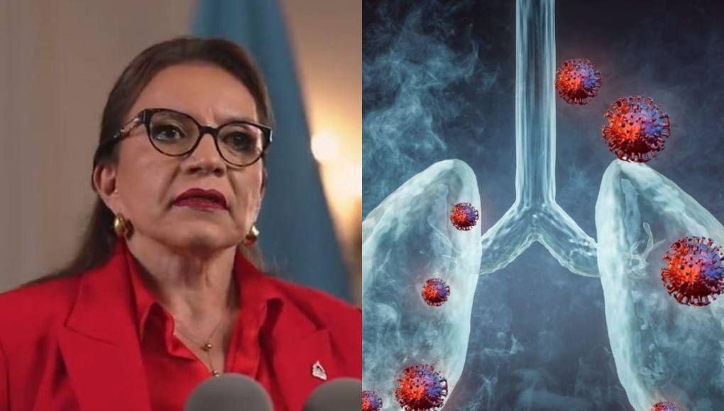 ¿Qué es bronquitis aguda, enfermedad diagnosticada a la presidenta Xiomara Castro?