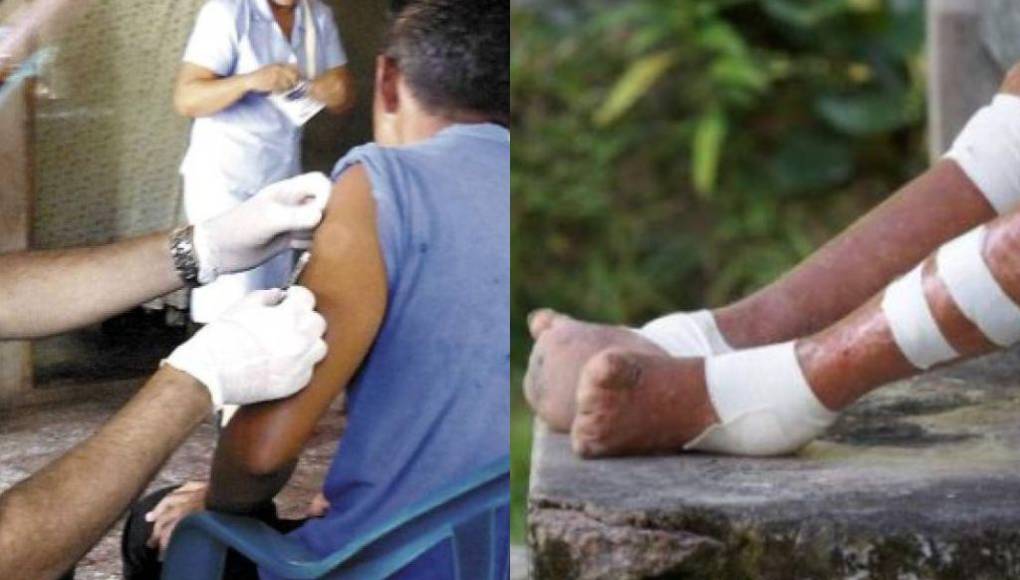 Alerta en Honduras por 16 casos de lepra: ¿cuáles son los síntomas y cómo protegerse?