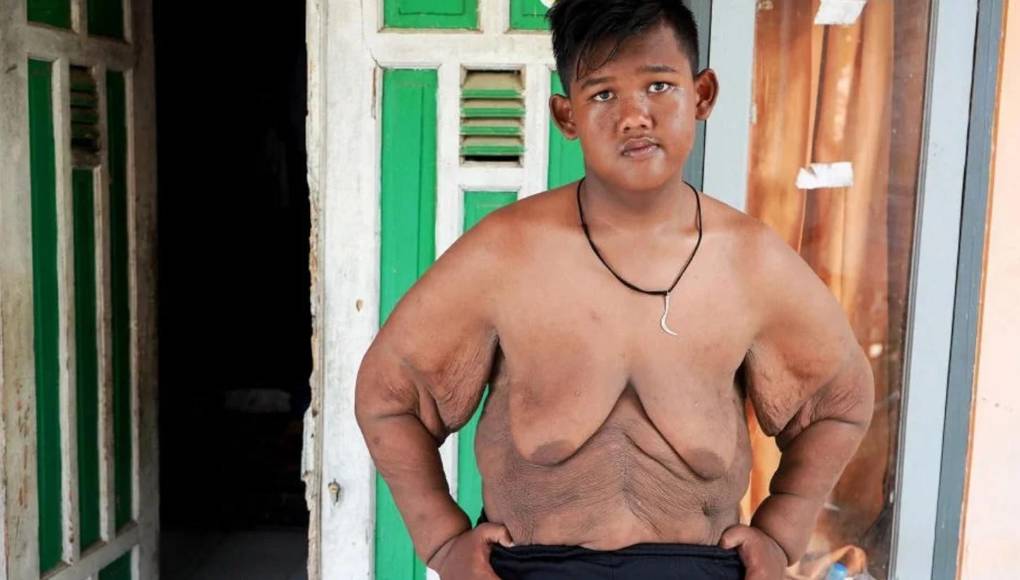 El impactante cambio físico de Arya Permana, el niño más gordo del mundo