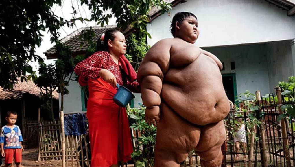 El impactante cambio físico de Arya Permana, el niño más gordo del mundo