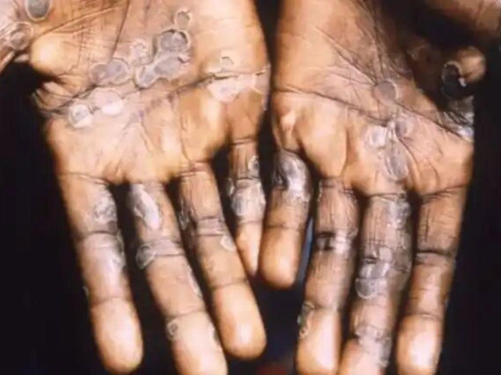 España y Brasil notifican primeras muertes por viruela del mono fuera de África