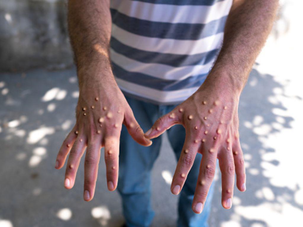 “Los peores dolores de mi vida”: un neoyorquino tras contagiarse de la viruela del mono