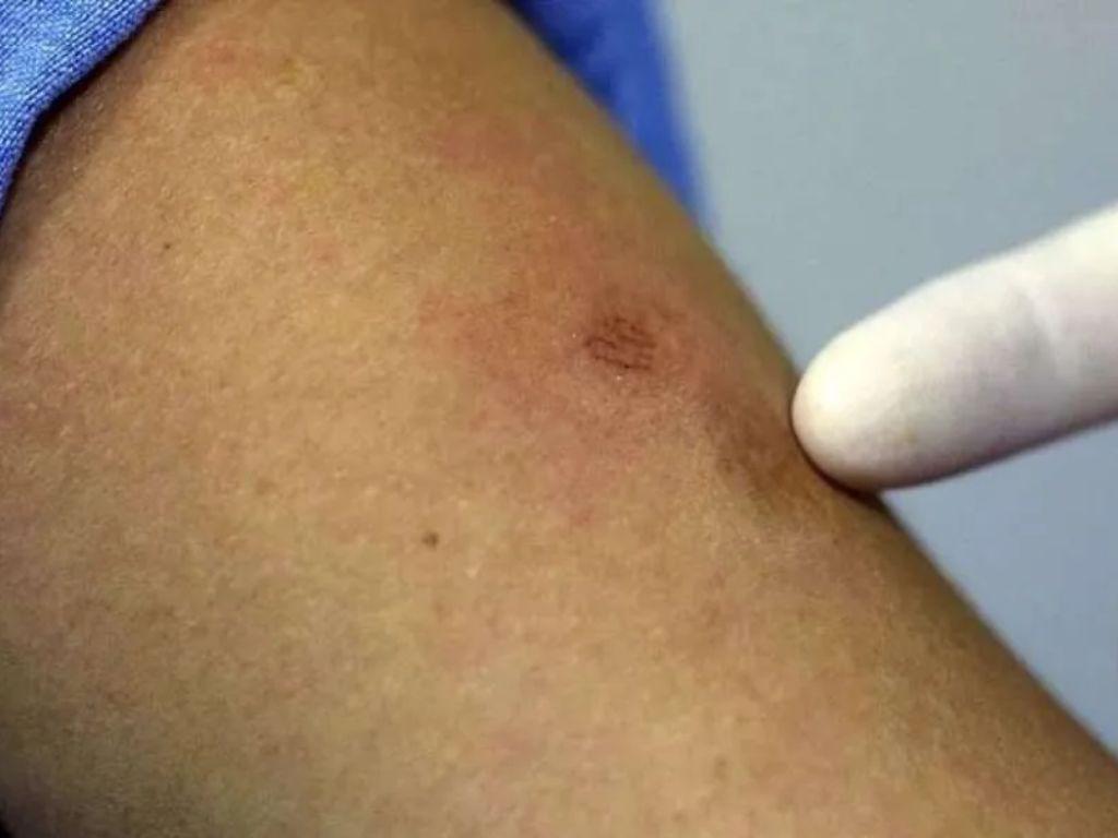 Guatemala confirma segundo caso de viruela del mono