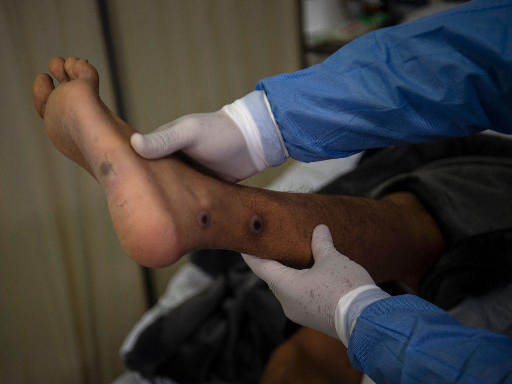 OMS pide a contagiados con la viruela del mono no exponer a sus animales al virus