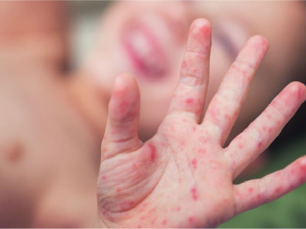 El virus que afecta a bebés y niños, ¿Qué es el coxsackie?