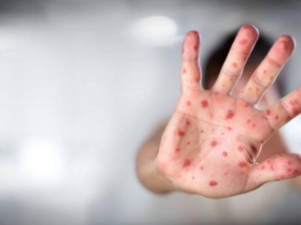 La OMS renombra dos variantes de la viruela del mono