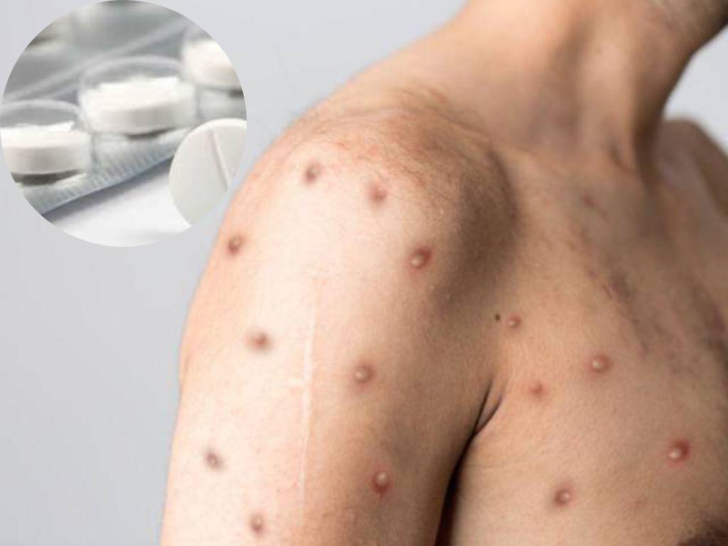 Con acetaminofén tratan a pacientes de la viruela símica