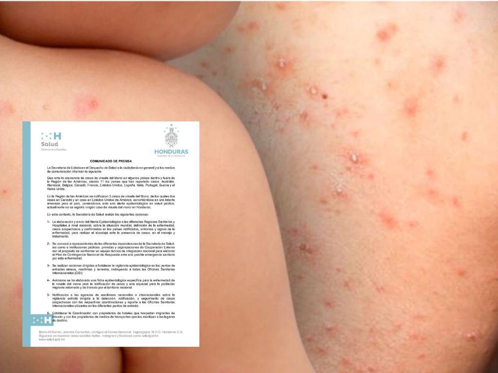 Honduras activa alerta epidemiológica ante la viruela del mono