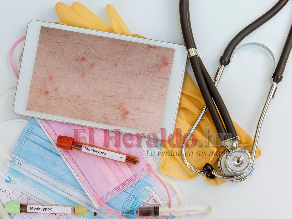 ¿Es posible detener el brote de viruela del mono?: Esto dice la OMS