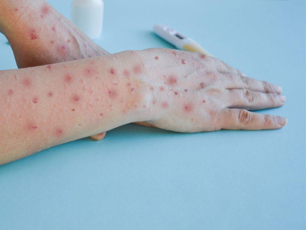 Capacitarán a personal de Salud para atender viruela del mono