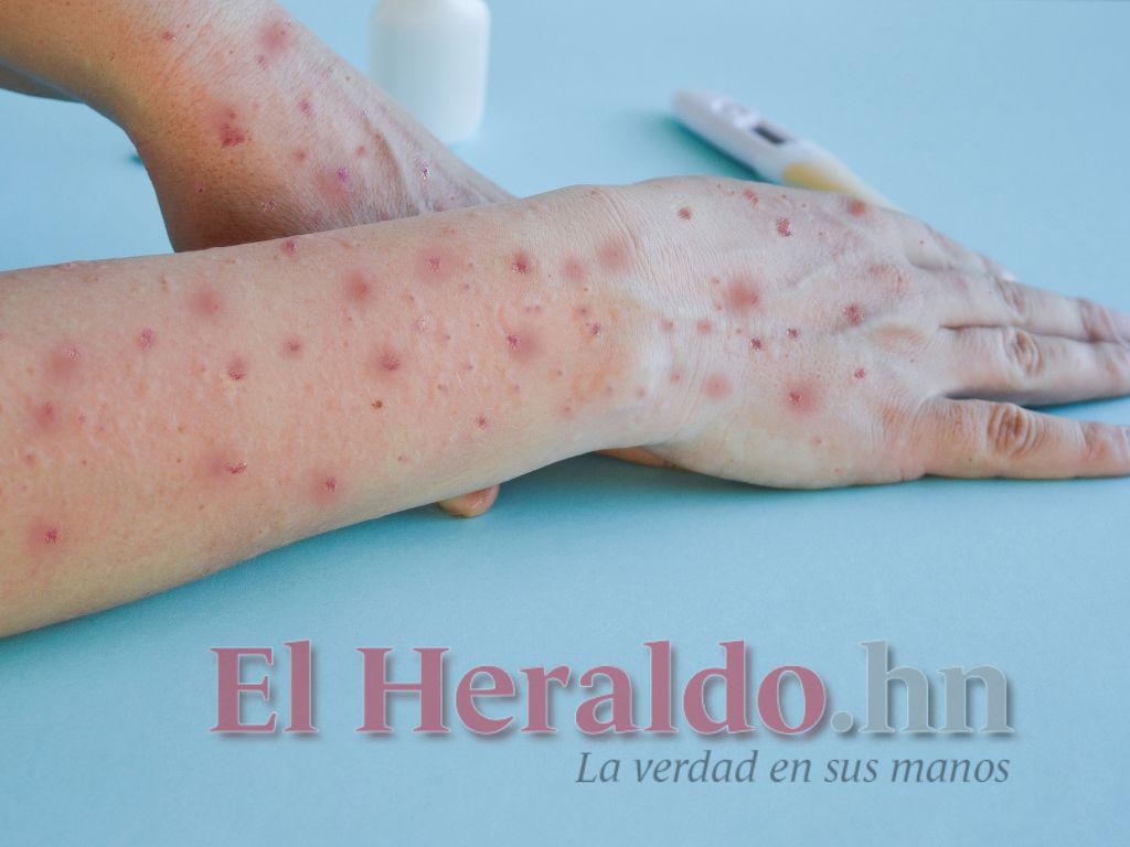 Recuperados los pacientes con viruela del mono en Honduras