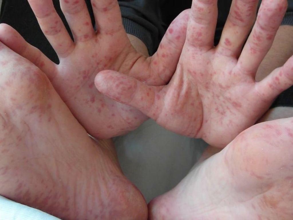 ¿Qué es el virus de coxsackie y cómo afecta a las personas?