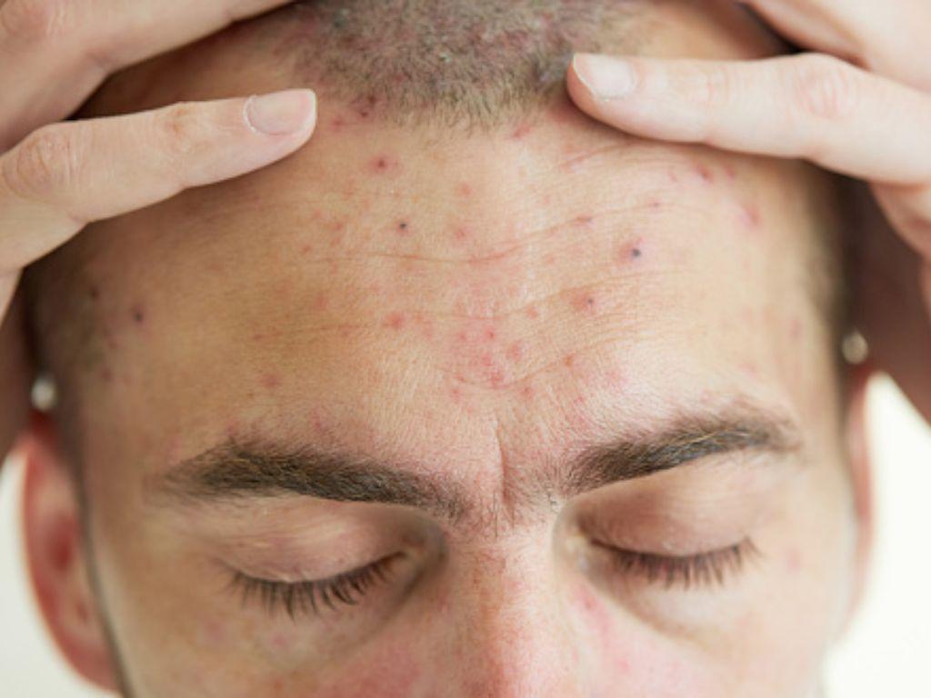 ¿Cuáles son? Las respuestas a las tres grandes dudas sobre la viruela del mono