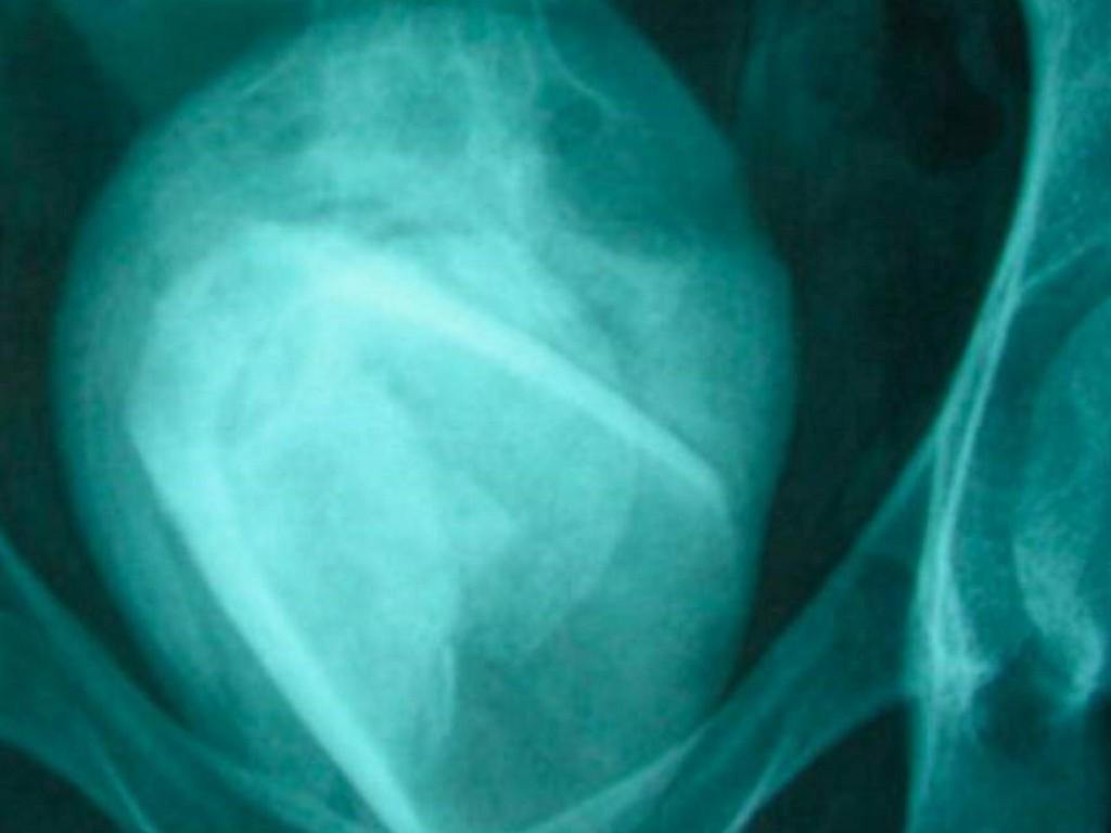 Hallan un vaso de vidrio en la vejiga de una mujer Hallan un vaso de vidrio en la vejiga de una mujer