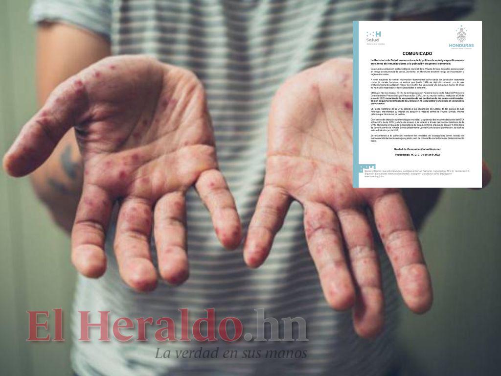 Salud: Población menor de 44 años no estaría vacunada contra viruela símica en Honduras