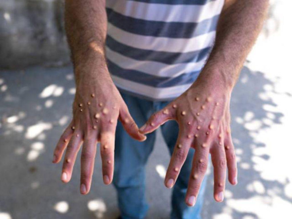 ¿ Por qué la OMS le cambiará el nombre a las variantes de la viruela del mono?