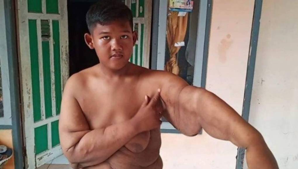 El impactante cambio físico de Arya Permana, el niño más gordo del mundo