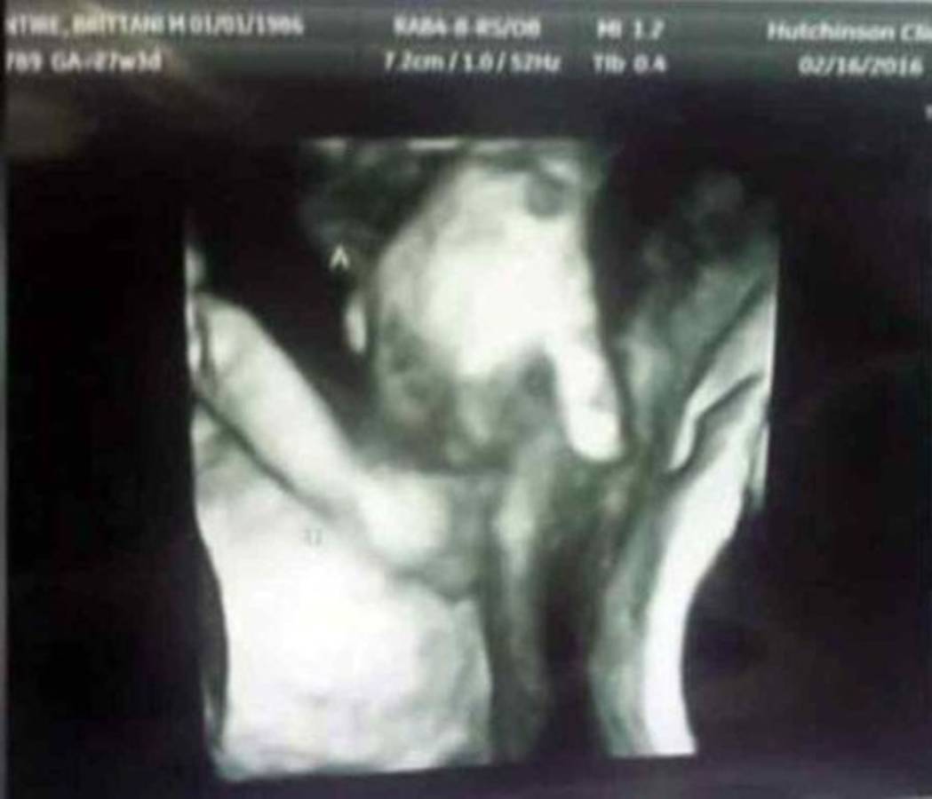 La imagen de dos gemelos tomados de la mano ha conmovido al mundo