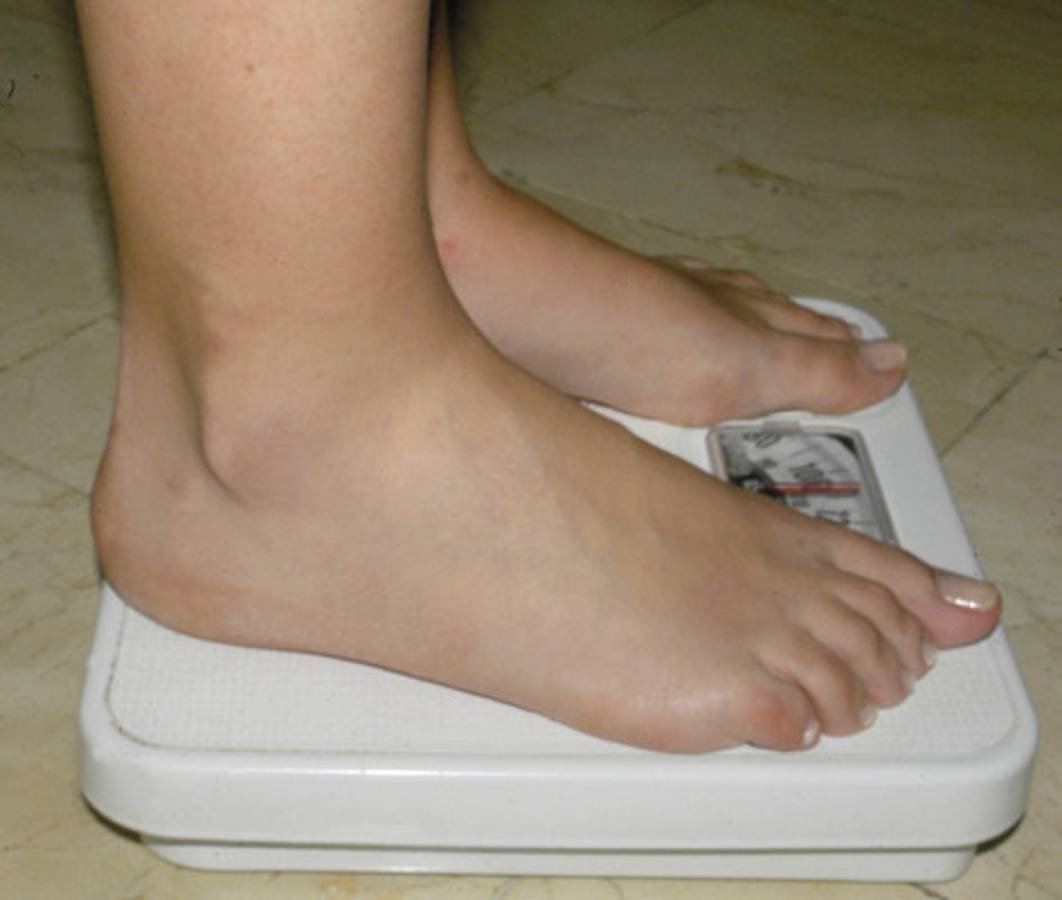 Resuelven el misterio del gen de la obesidad