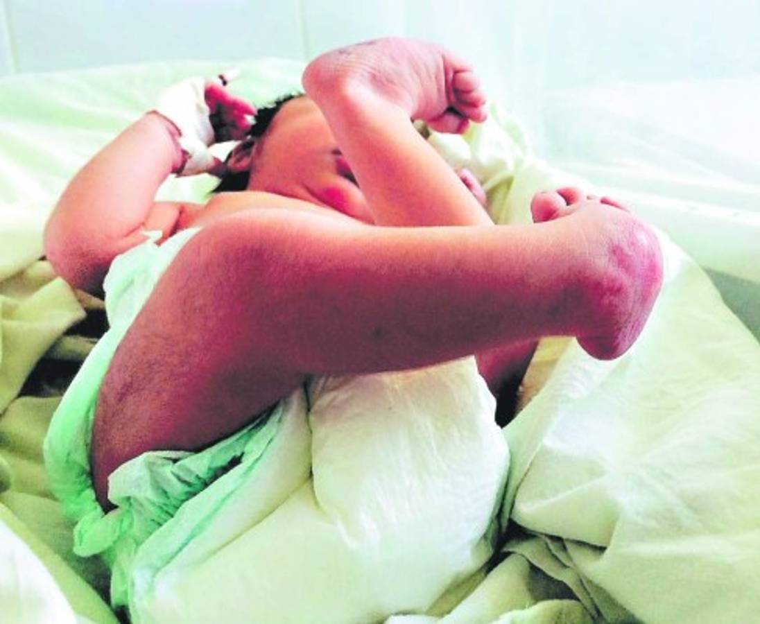 Honduras: Nacen siete niños más con microcefalia