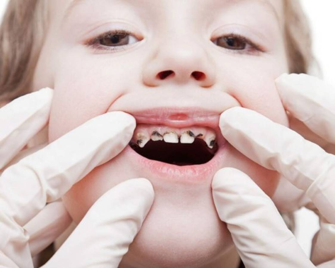 ¿Qué enfermedades pueden ocasionar las caries dentales?