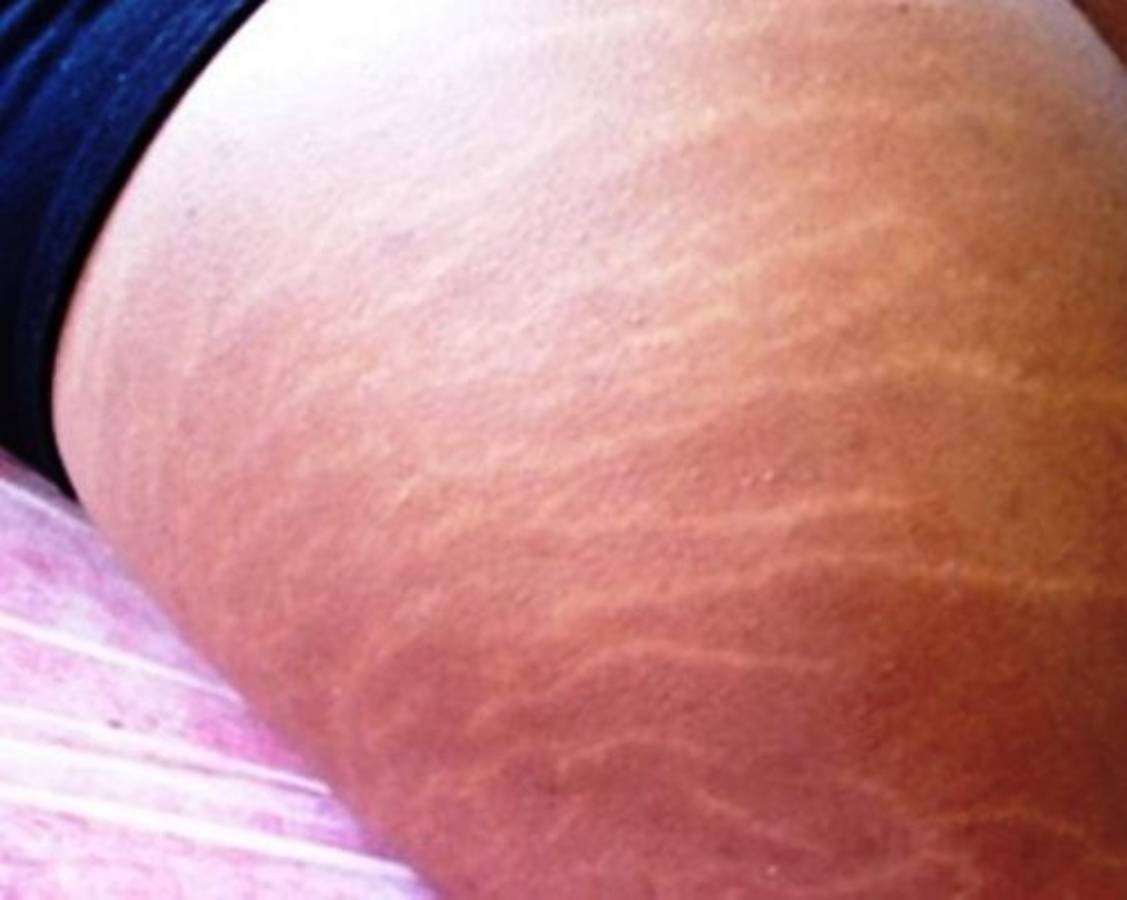 Trucos contra las estrías