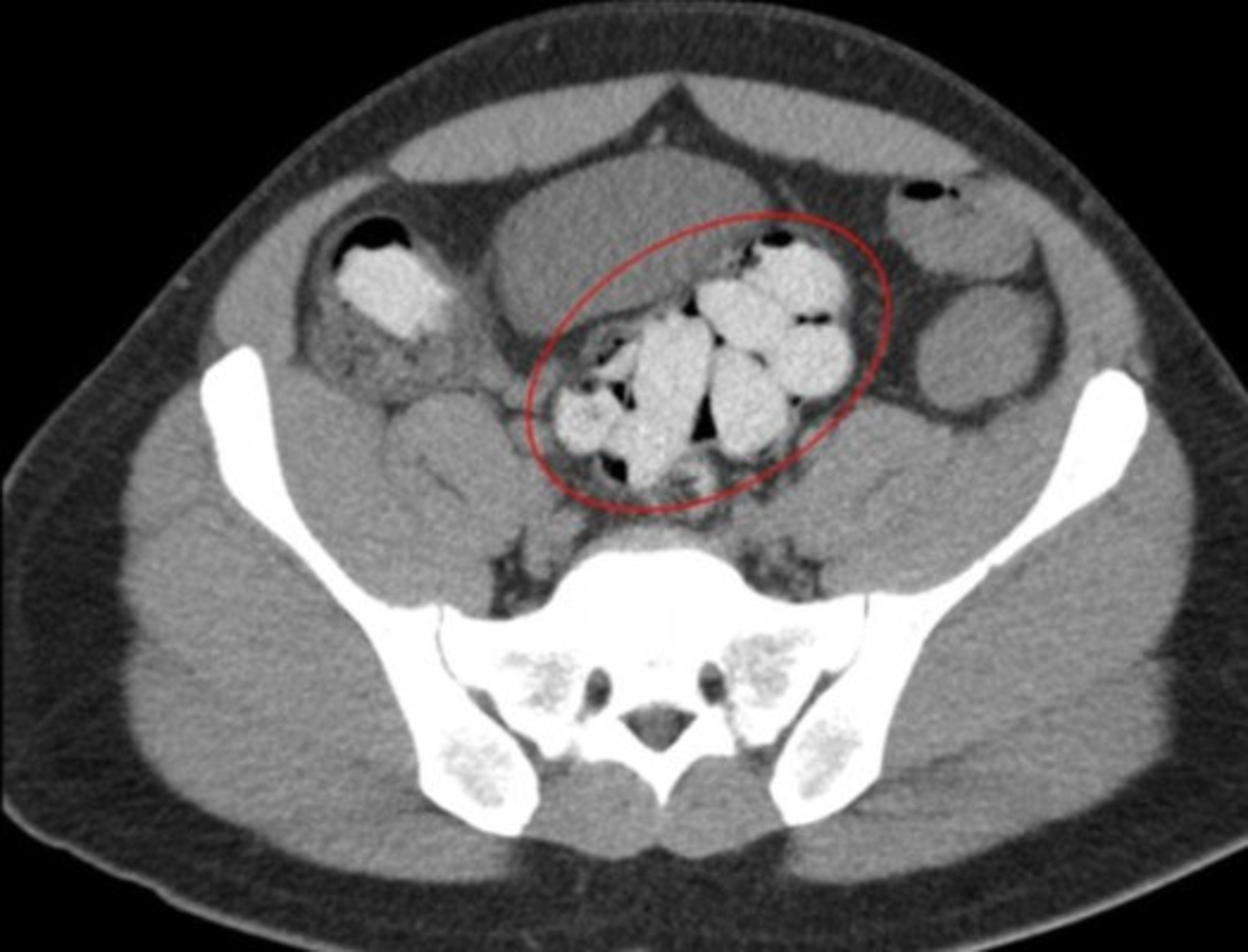 Tres mujeres que traficaban cocaína en el estómago mueren en Venezuela