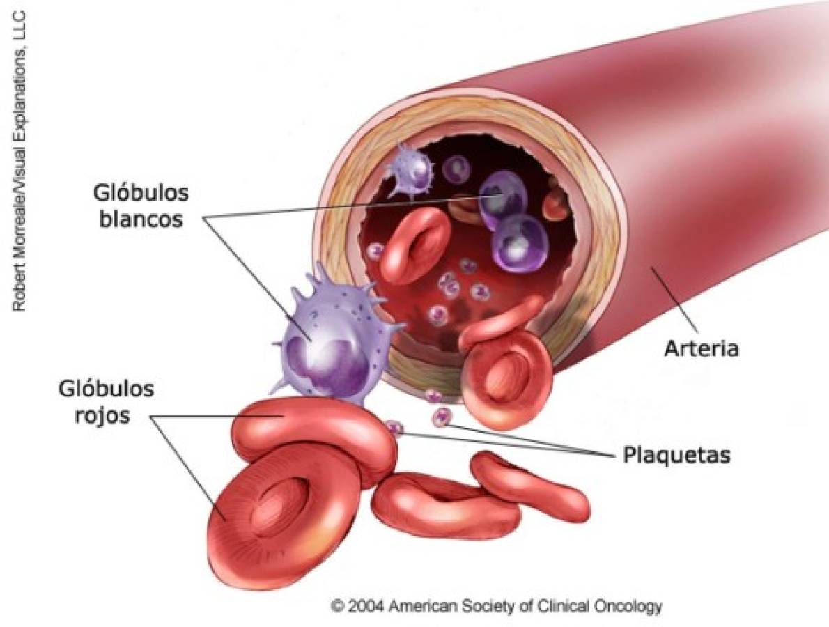 Aquí se muestran a detalle los factores sanguíneos que afecta esta enfermedad.