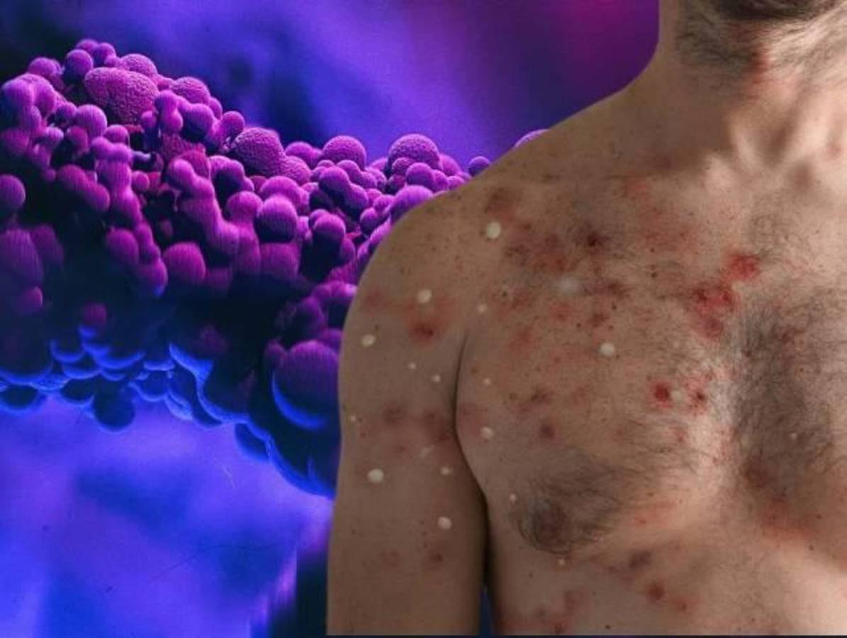 ¿Cuántos casos de viruela del mono se registran en Centroamérica?