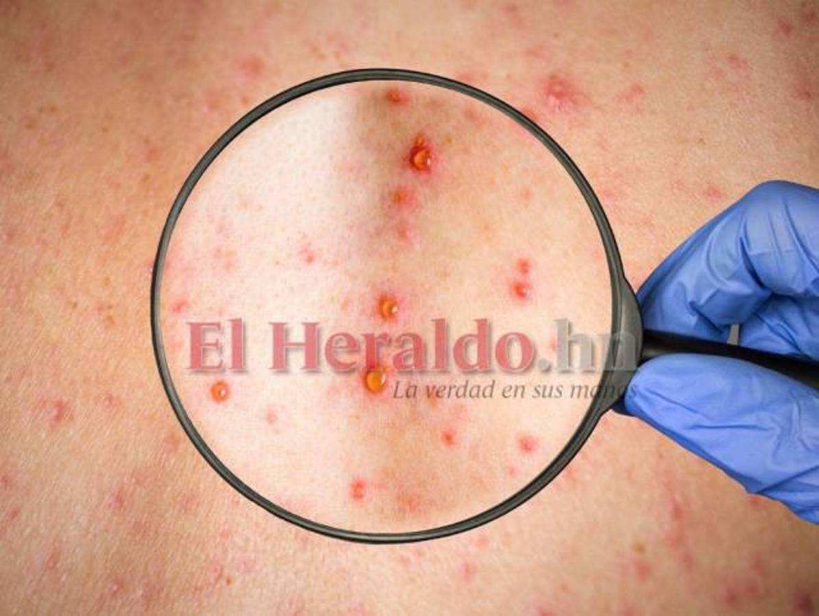 Se registran dos casos más de Viruela Símica en Honduras: ya se totalizan seis