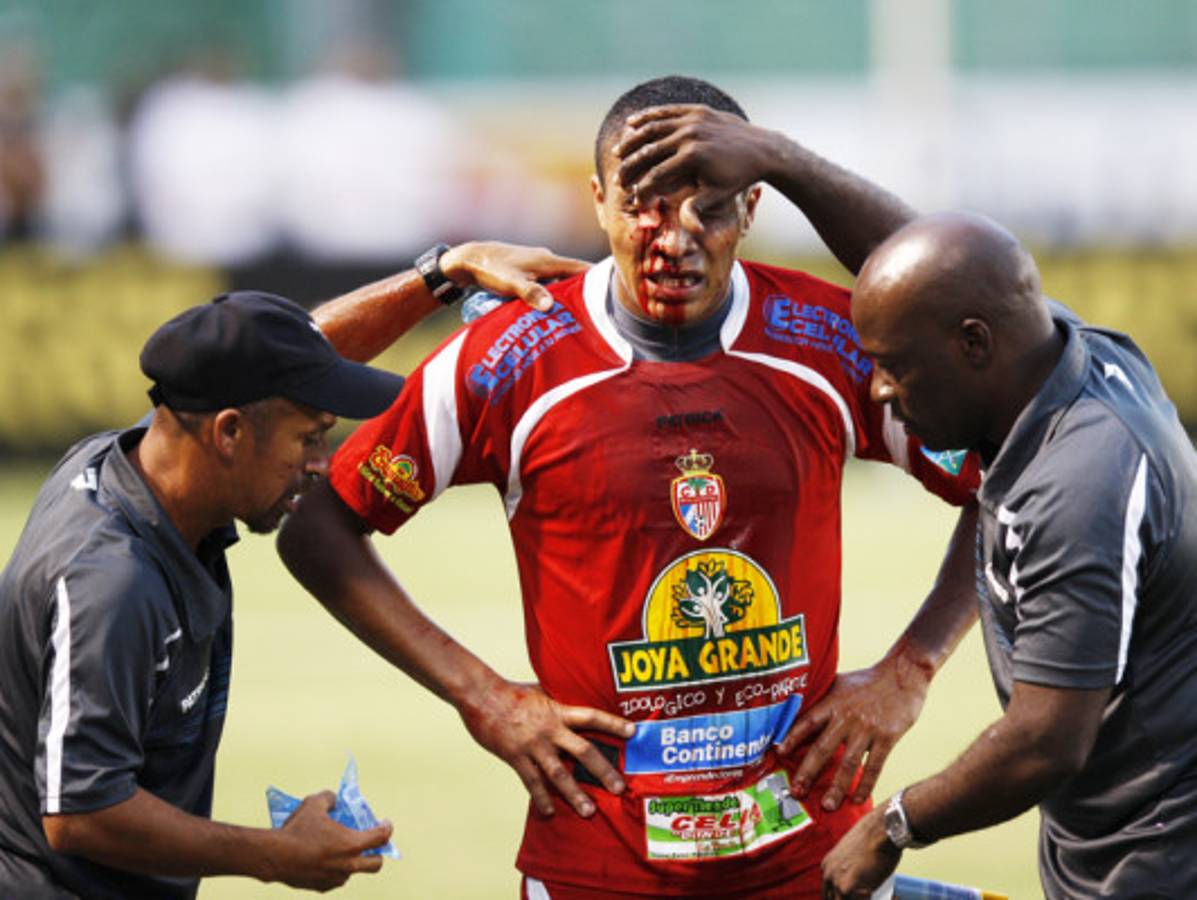 FOTOS: Rambo termina ante Olimpia con el rostro ensangrentado