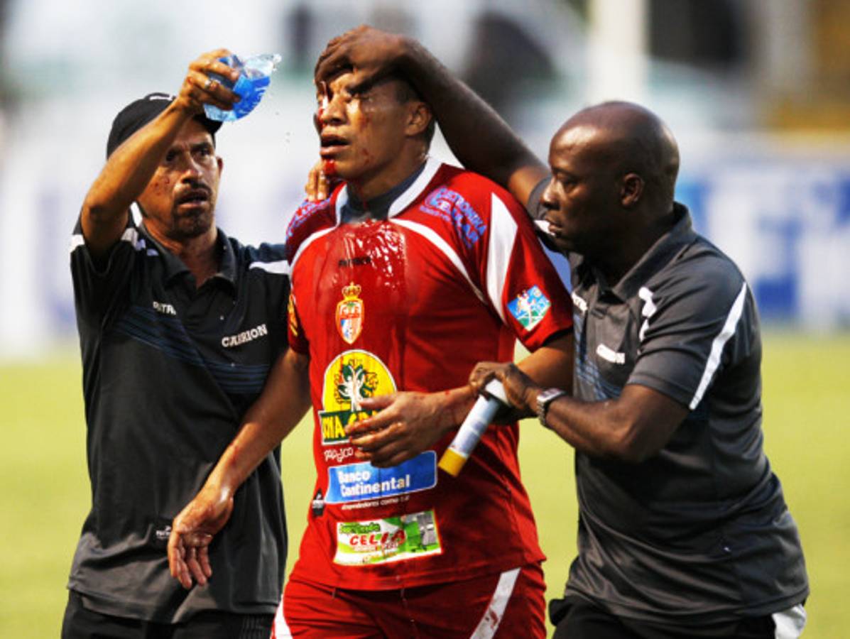 FOTOS: Rambo termina ante Olimpia con el rostro ensangrentado